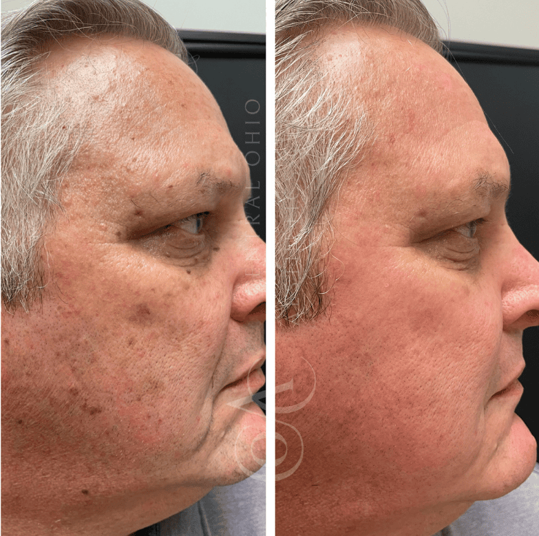 Side-by-side images of a man's face show a noticeable reduction in dark spots and smoother skin on the right side, highlighting improved complexion.