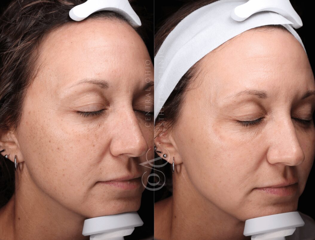 A woman wearing a headband shows her face before and after using a facial device, highlighting visible skin improvements.
