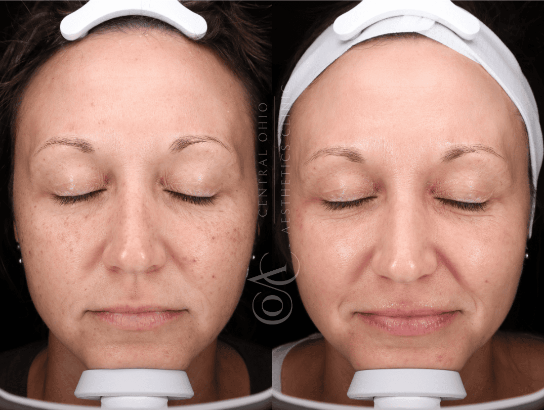 Side-by-side images of a woman's face before and after a skincare treatment. Left shows visible freckles and blemishes; right shows smoother, clearer skin.