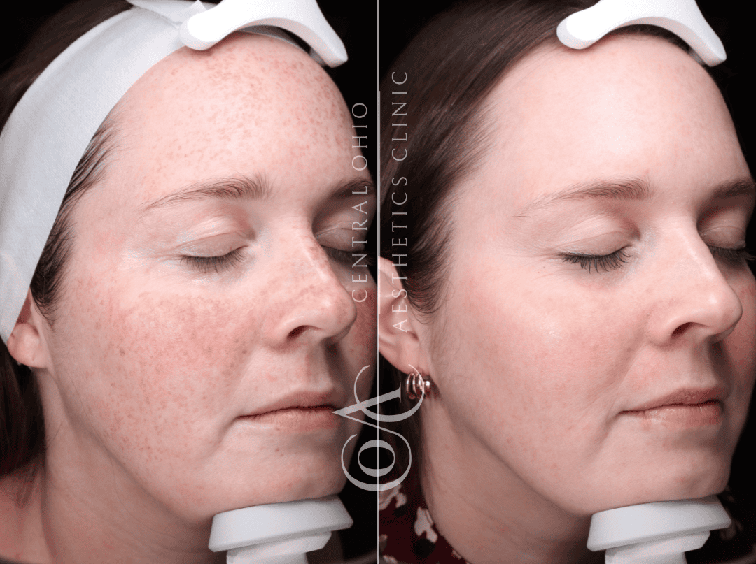 Before and after photos of a woman showcasing her freckles, highlighting a transformation in her appearance.