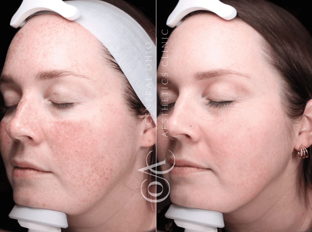 Woman's face showing red spots before treatment, and a clear complexion after treatment, highlighting the improvement.
