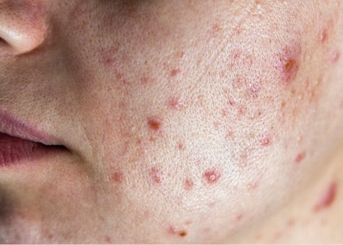 Acne