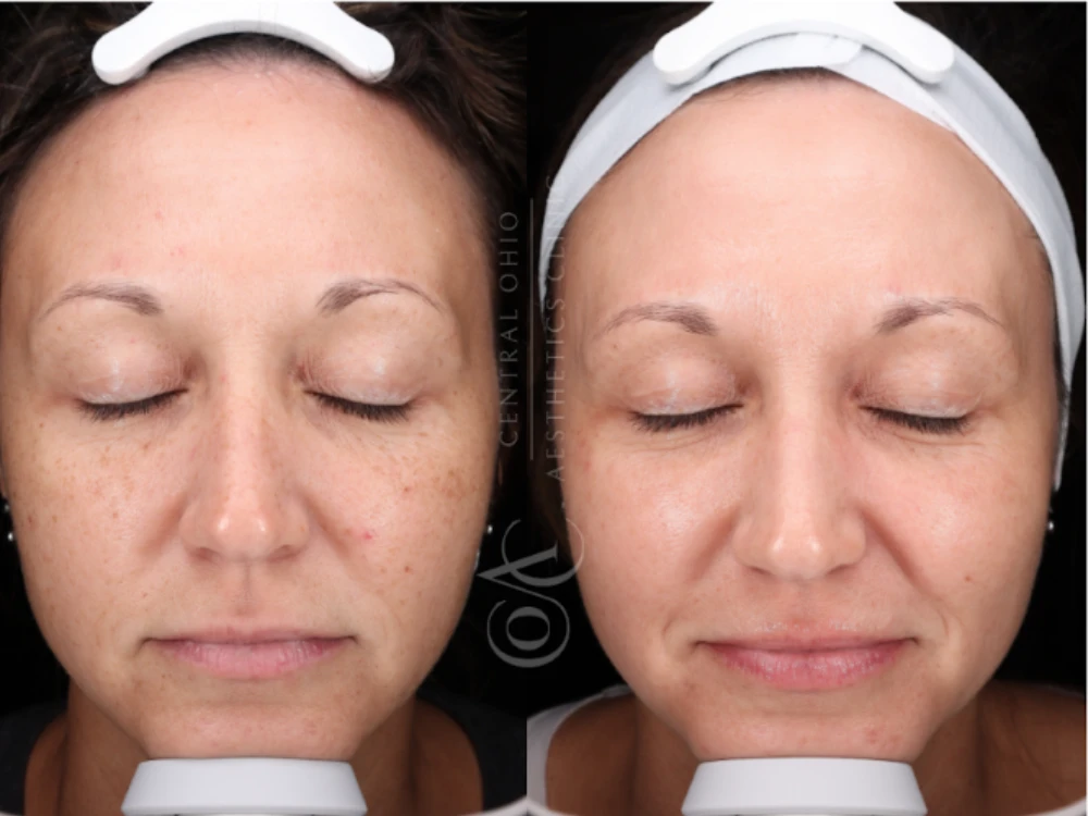 Side-by-side comparison of a woman's face before and after a skincare treatment; left shows freckles and redness, right shows smoother, more even skin tone. Side-by-side comparison of a woman's face before and after a skincare treatment; left shows freckles and redness, right shows smoother, more even skin tone.