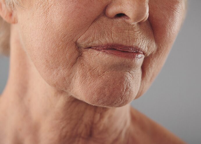 Aging Skin