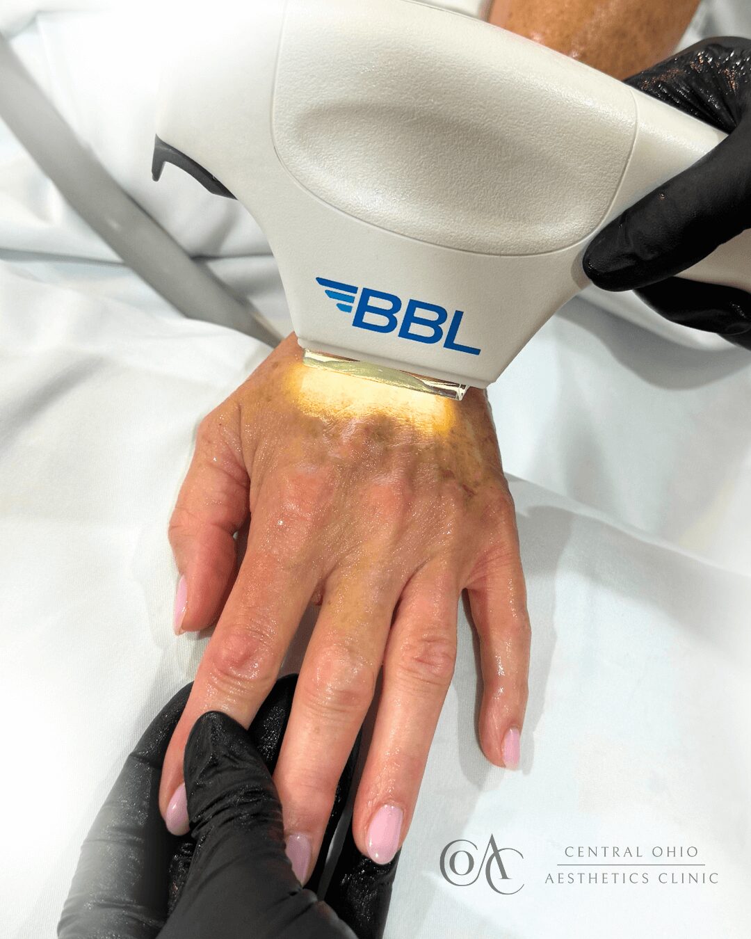 A person receiving laser treatment on their skin, focusing on improving texture and appearance.