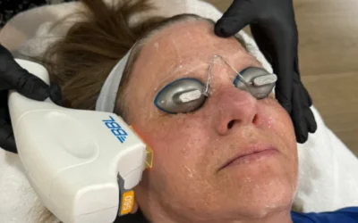 BBL Laser Aftercare in Powell, Ohio
