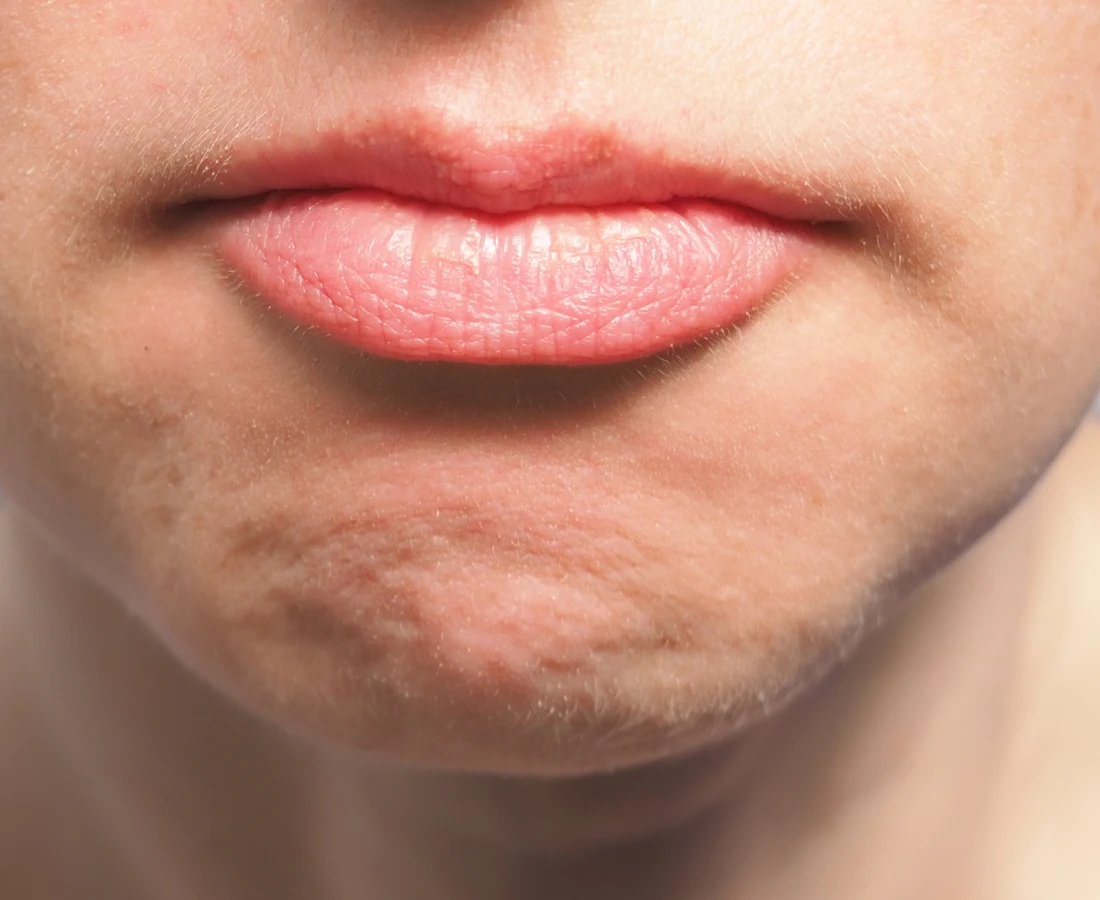 Chin Filler Treatment in Powell, Oh