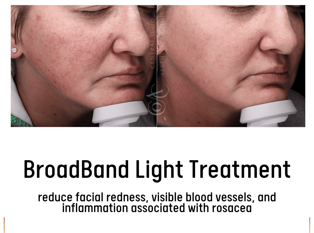 Before and after photos showing a woman's skin improvement from using a skincare regimen.