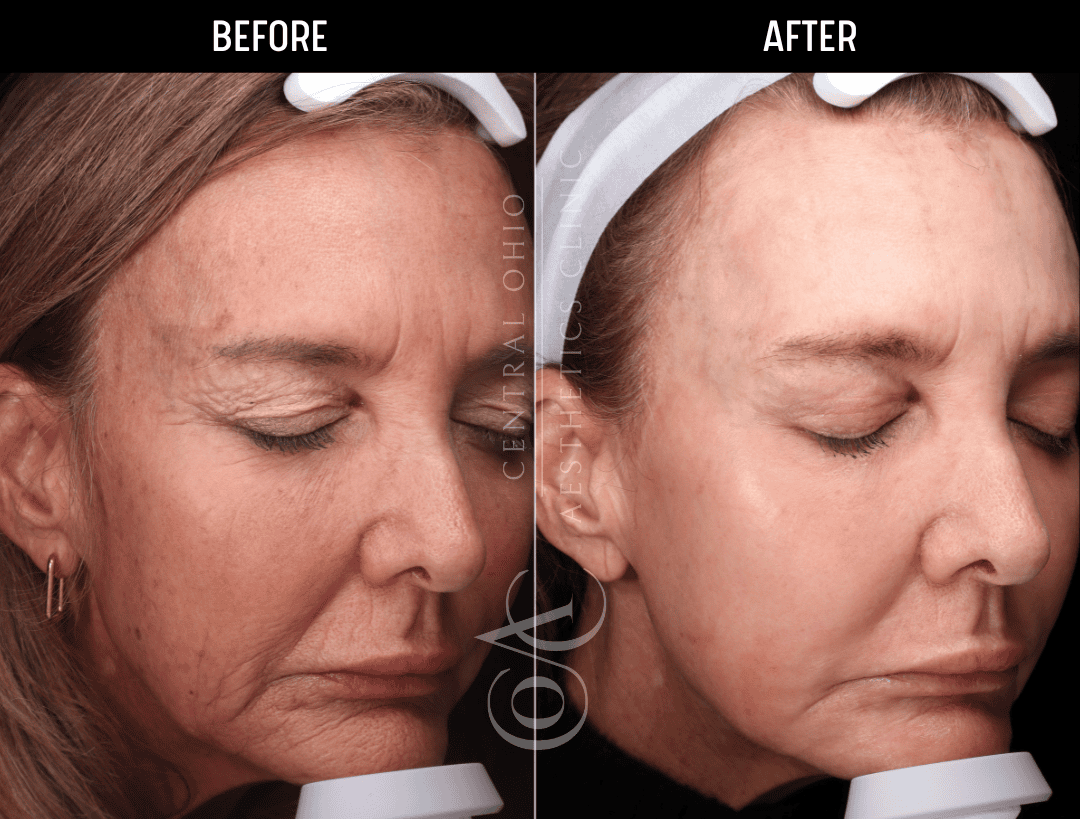 Skin Resurfacing