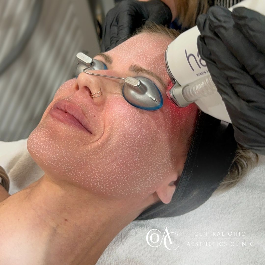 A woman undergoing a laser treatment on her face, focused on skincare and beauty enhancement.