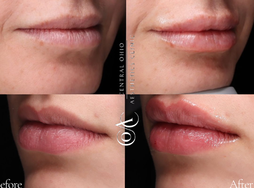 Dermal Fillers Before and After Result