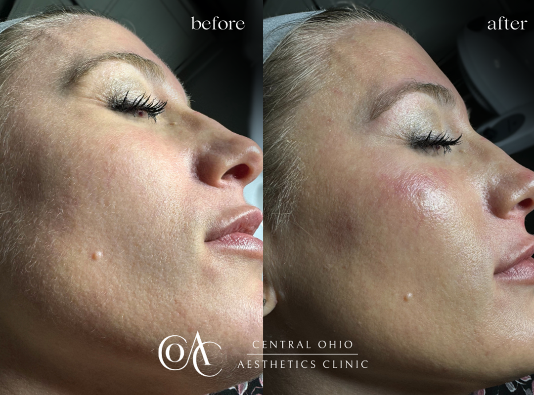 Dermaplaning Treatment Before and After Result