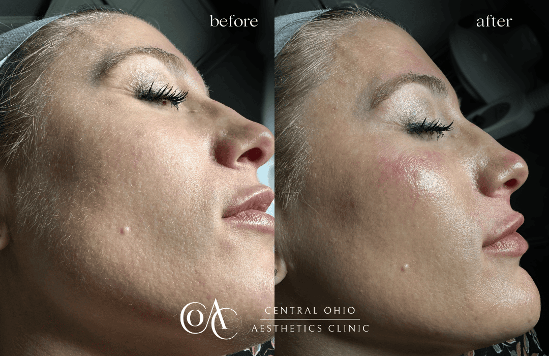 Dermaplaning Before and After