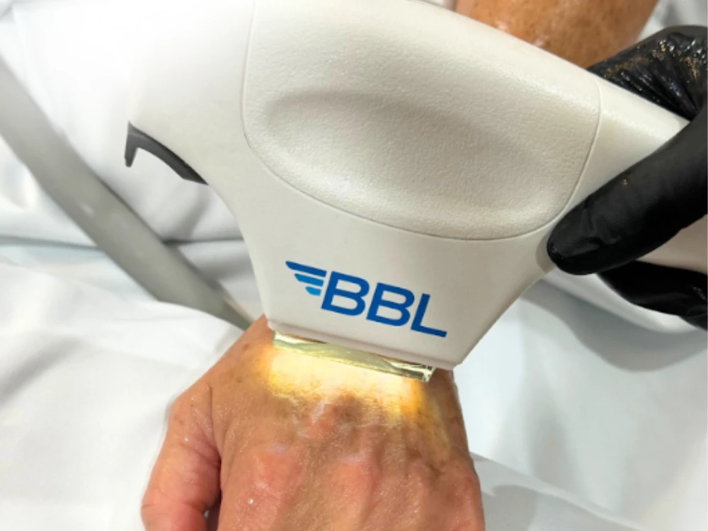 A cosmetic procedure with a BBL device on a person's hand, emitting light. The technician wears black gloves. The setting is clinical and professional. A cosmetic procedure with a BBL device on a person's hand, emitting light. The technician wears black gloves. The setting is clinical and professional.