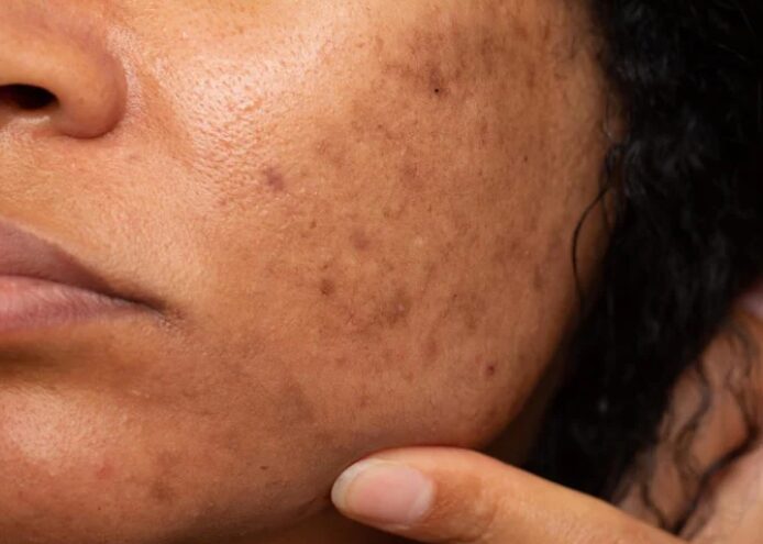 Close-up of a person's cheek showing hyperpigmentation and dark spots. A finger gently touches the skin, conveying concern for skincare.