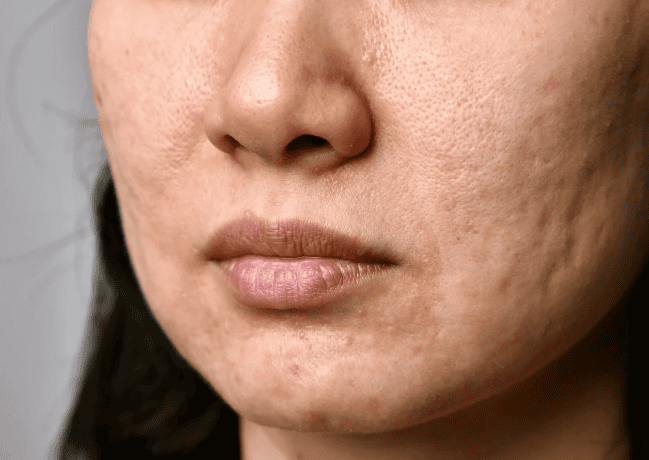 Enlarged pores