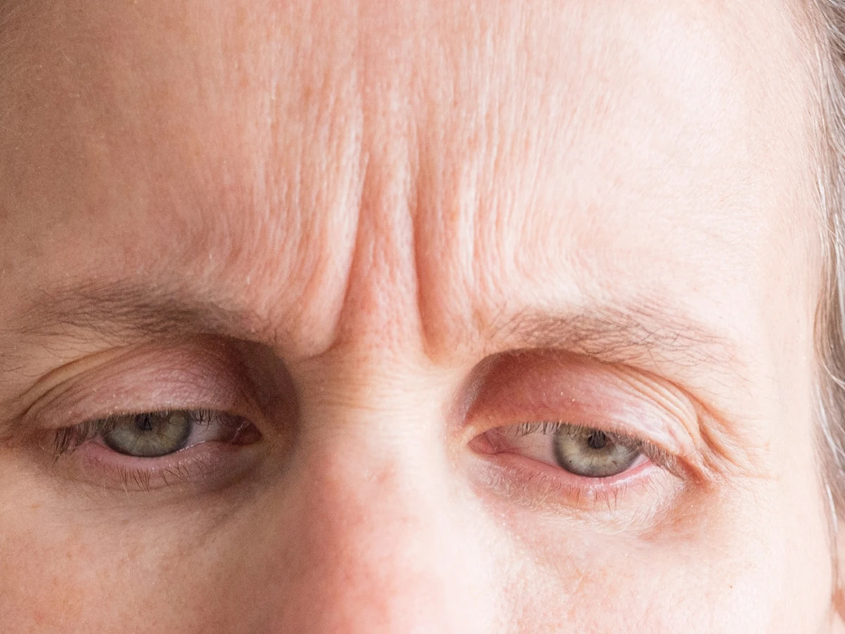 Frown Line Treatment in Powell, Ohio