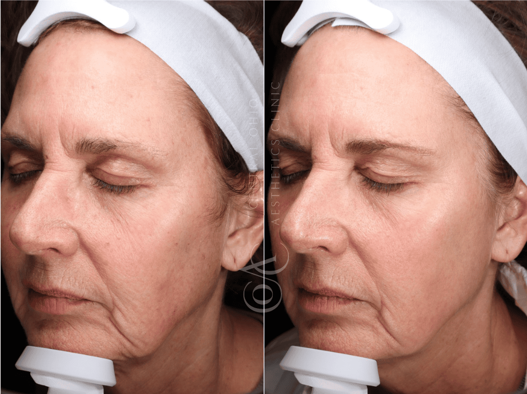Before and after photo showing a woman with reduced wrinkles, highlighting the effects of skincare treatment.
