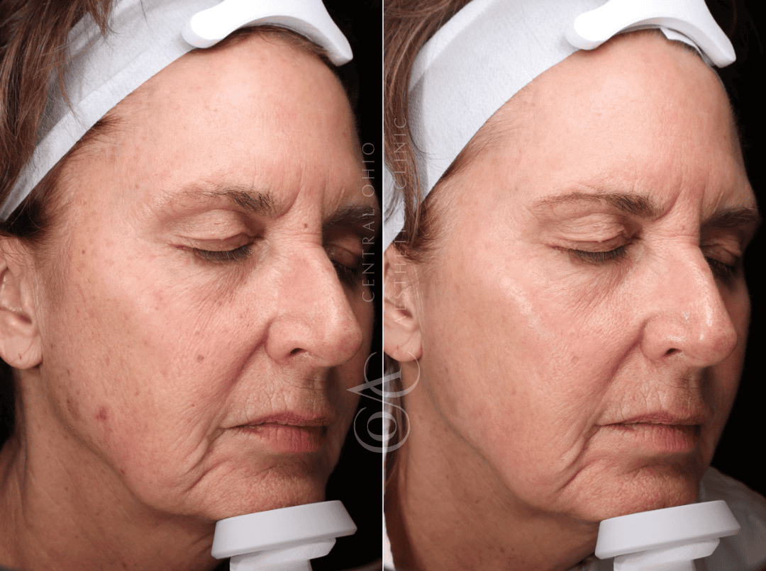 Before and after photo showing a woman's skin improvement from using skincare products.