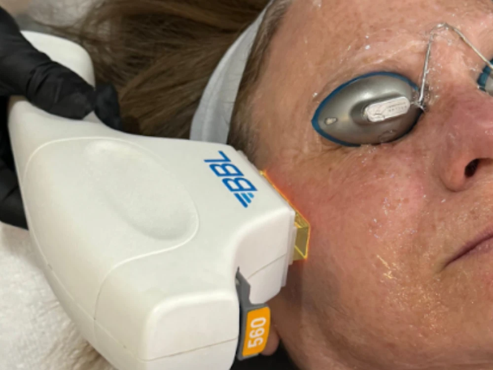 A close-up of a woman's face receiving a BBL laser treatment. She wears protective goggles and has gel on her skin. A technician holds the device. A close-up of a woman's face receiving a BBL laser treatment. She wears protective goggles and has gel on her skin. A technician holds the device.