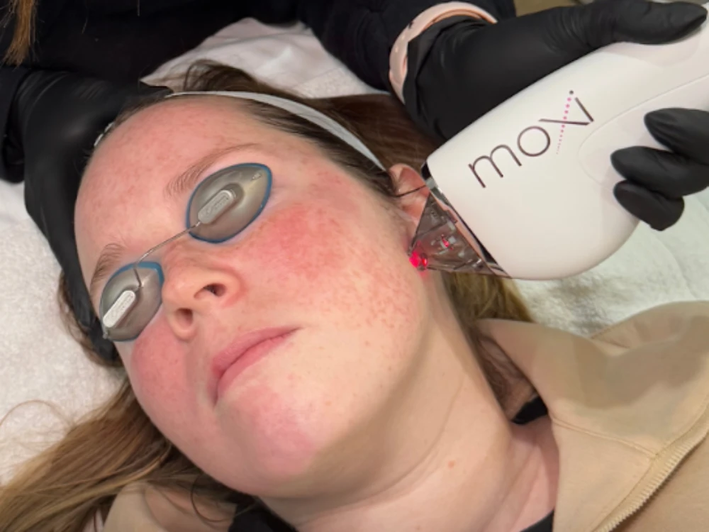 A woman with closed eyes, wearing protective goggles, undergoes a laser facial treatment. A device held by a gloved hand emits a red light on her cheek. A woman with closed eyes, wearing protective goggles, undergoes a laser facial treatment. A device held by a gloved hand emits a red light on her cheek.