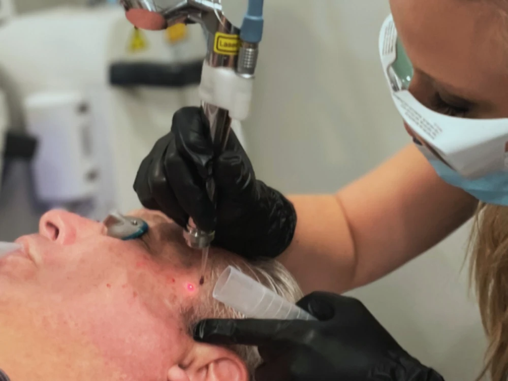 A technician wearing protective glasses and gloves performs a laser treatment on a man's face, focusing on a specific spot near his temple. A technician wearing protective glasses and gloves performs a laser treatment on a man's face, focusing on a specific spot near his temple.