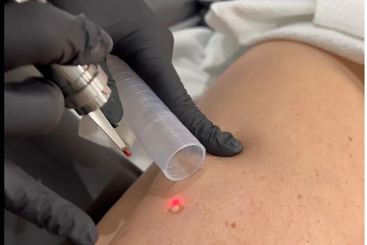 Laser Resurfacing (Ablative vs Non-Ablative)