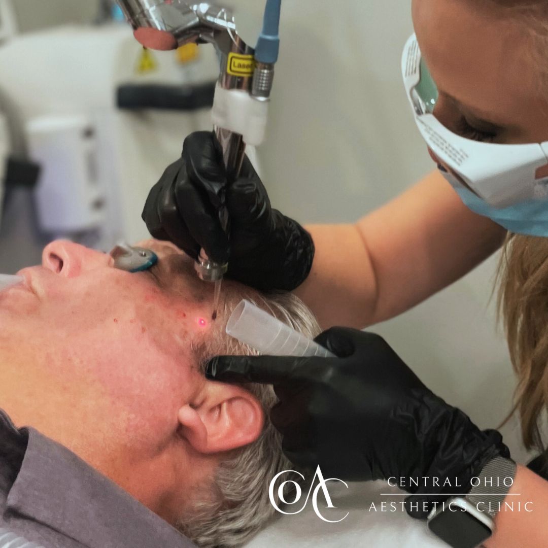 Laser Skin Resurfacing Process