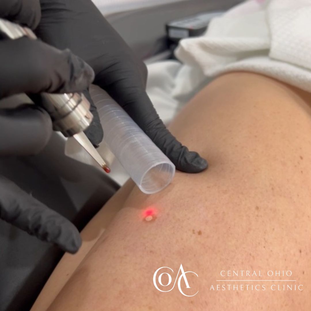 Laser Skin Resurfacing Process Leg