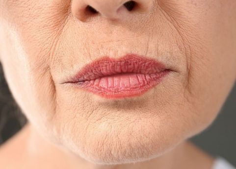 Lip lines and lip flip