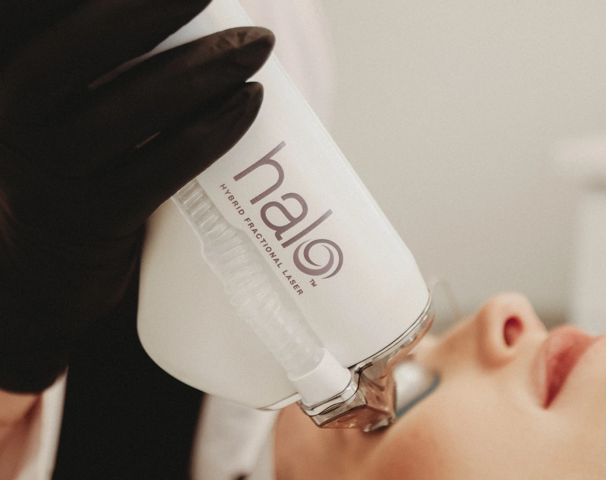 Marionette Lines - HALO™ Laser Treatment in Powell, OH