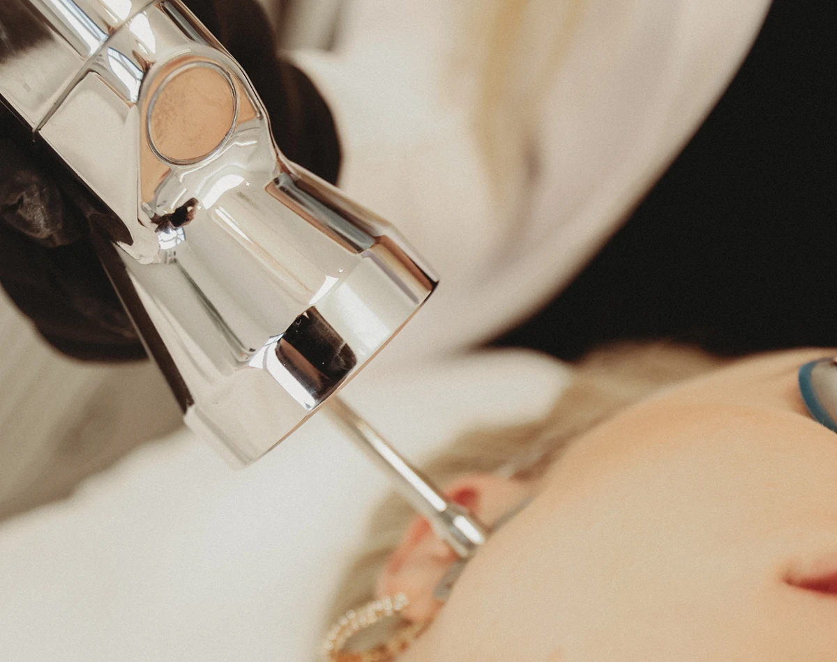 Marionette Lines - Laser Skin Resurfacing in Powell, OH