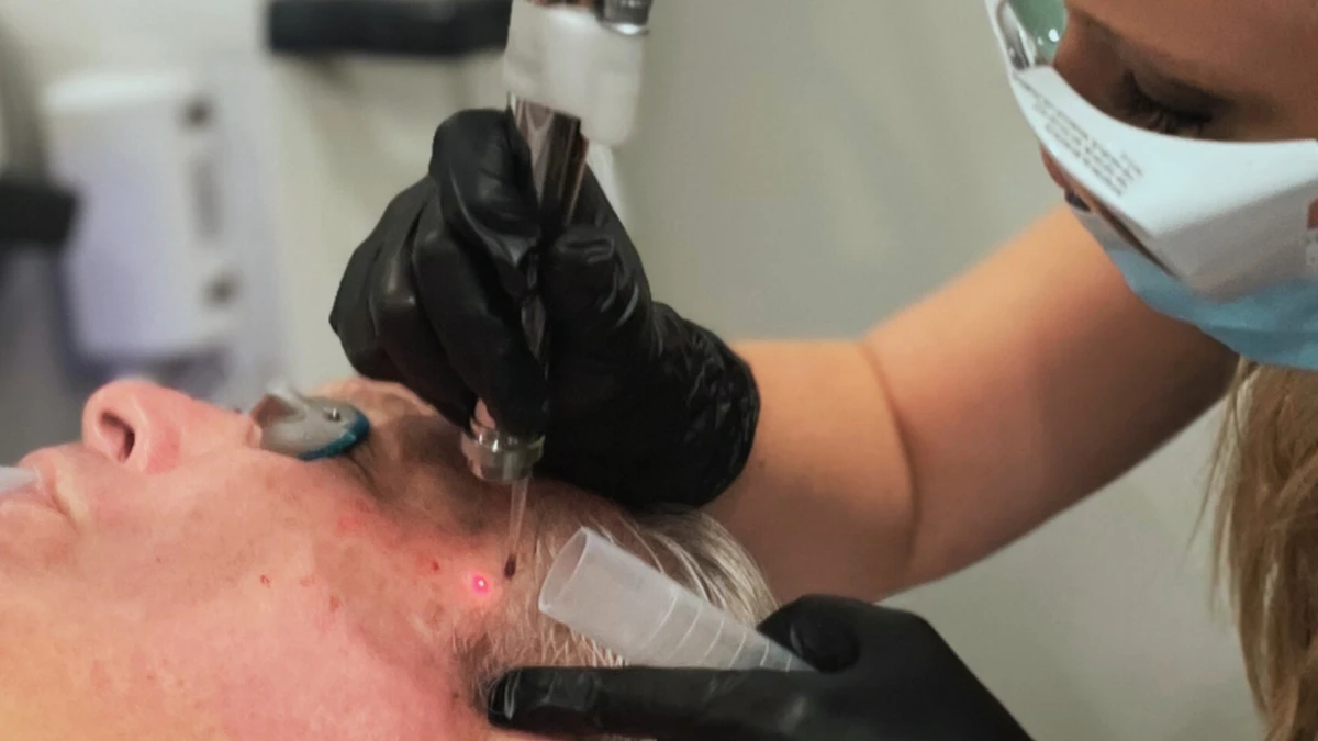 Profractional Laser for Deeper Skin Resurfacing Support in Powell, Ohio