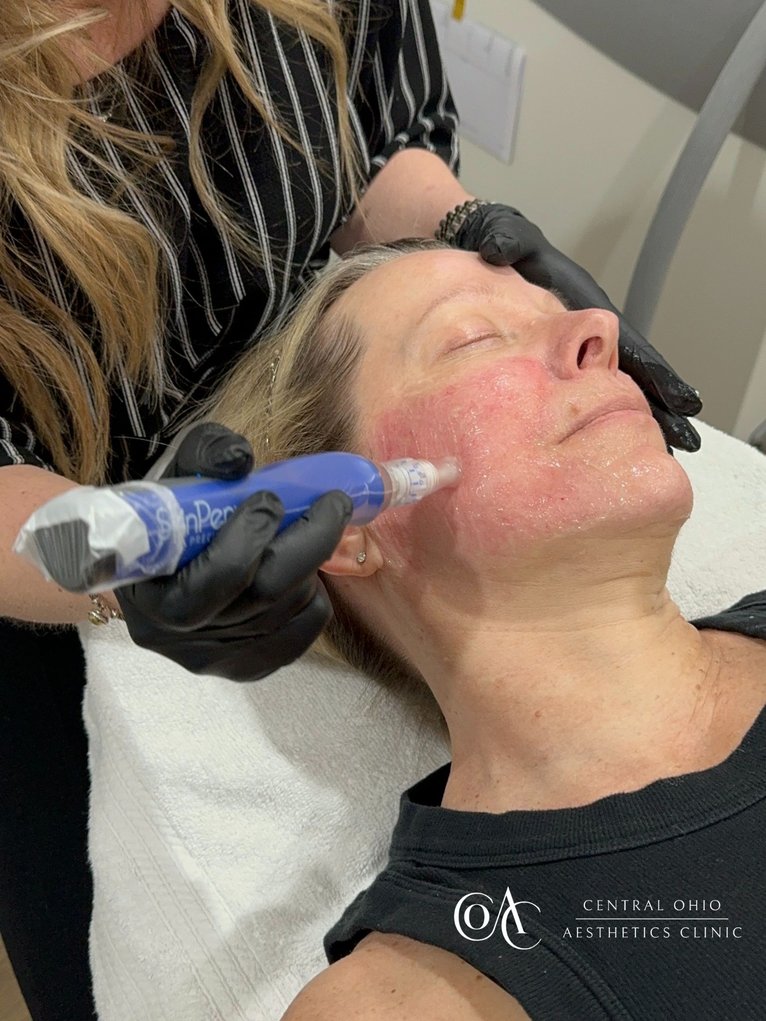 A woman receives a microneedling treatment on her cheek at a clinic. A practitioner in gloves holds a device, gently applying it to the skin.