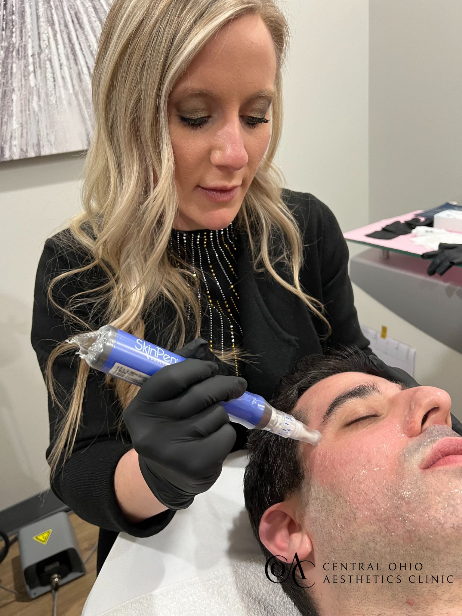 Microneedling Treatment
