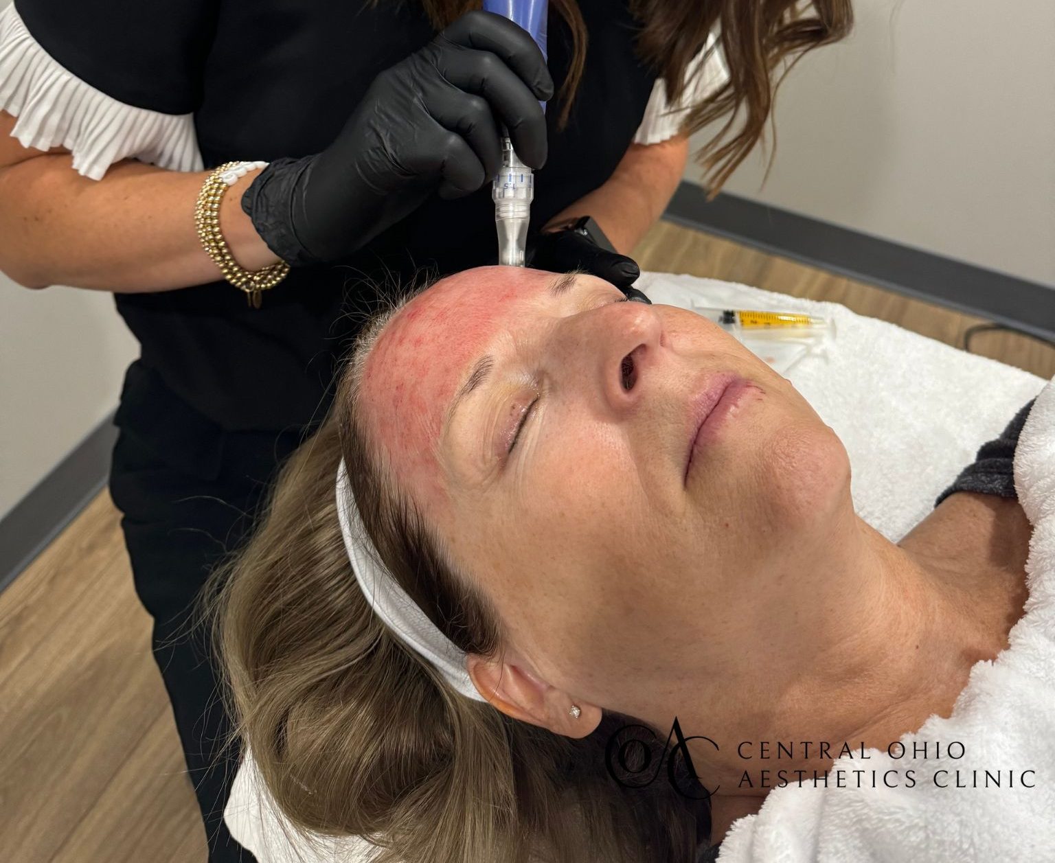 What Is Microneedling