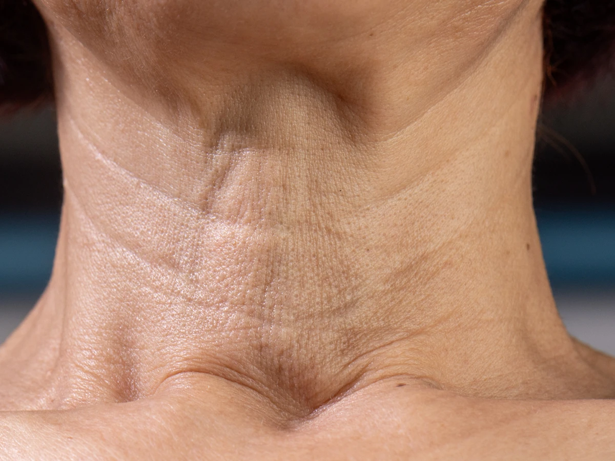 Neck Lines Treatment in Powell, Oh