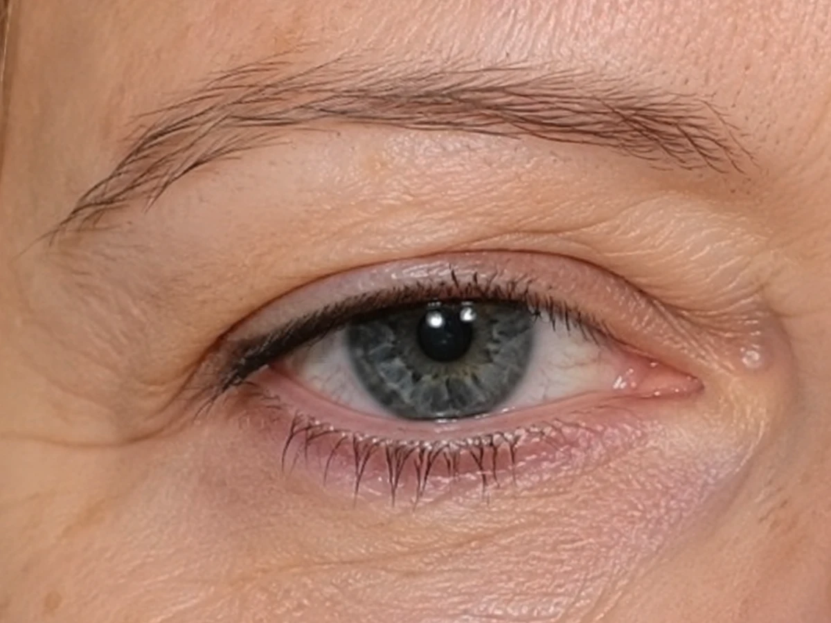 Non-Surgical Brow Lift Treatment in Powell, OH