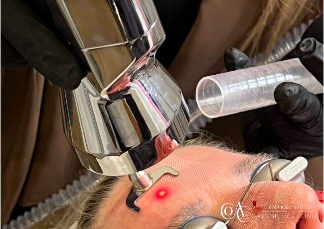 ProFractional&trade; Laser