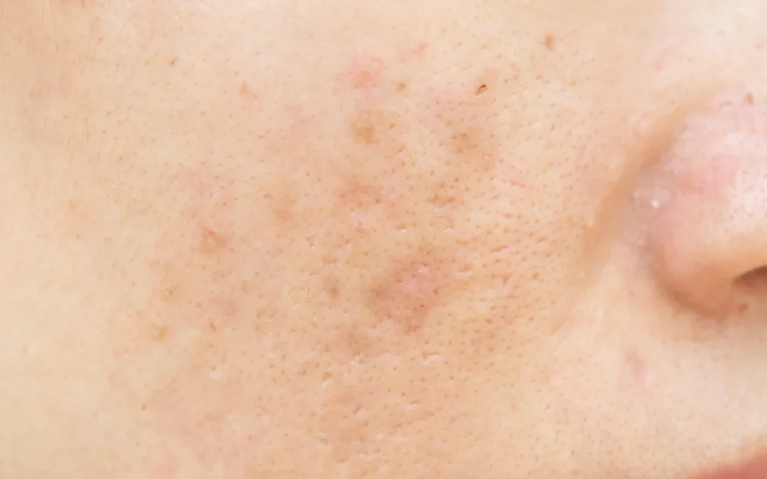 Professional Laser Treatment for Dark Spots: What You Need to Know