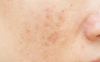 Professional Laser Treatment for Dark Spots: What You Need to Know