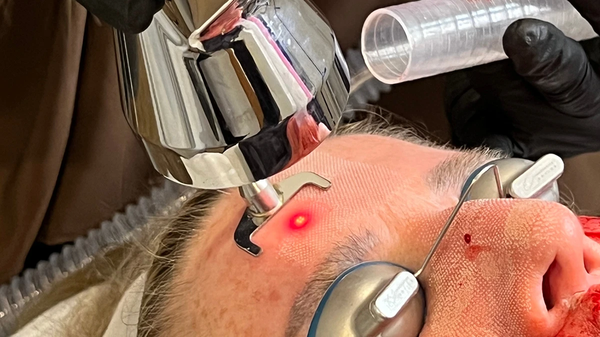 Profractional Laser for Deeper Skin Resurfacing Support in Powell, Ohio