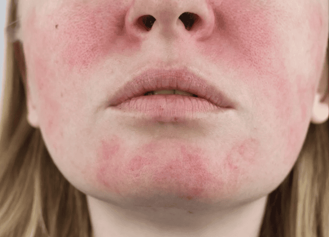 Redness and sensitivity