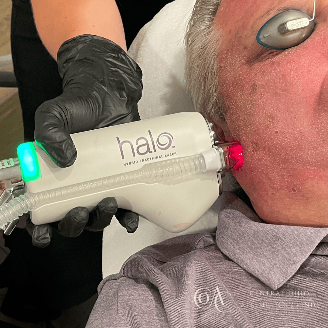 A man receiving a hair cut using a Halo Laser treatment in a clinic setting, showcasing advanced skin rejuvenation technology.