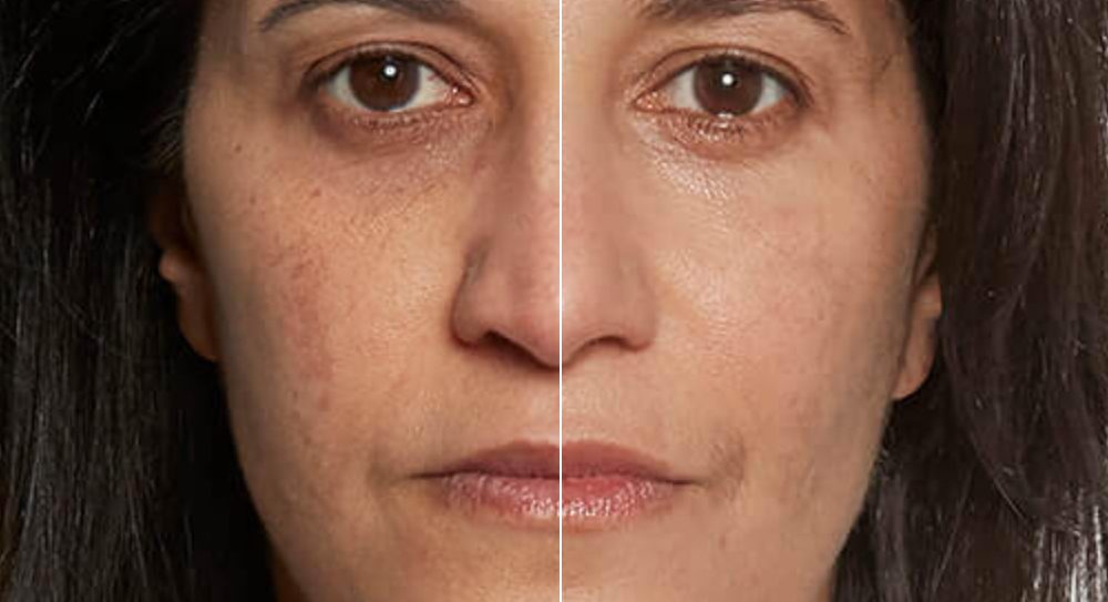 woman's wrinkles face before and after