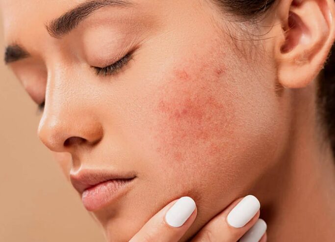 Sensitive Skin