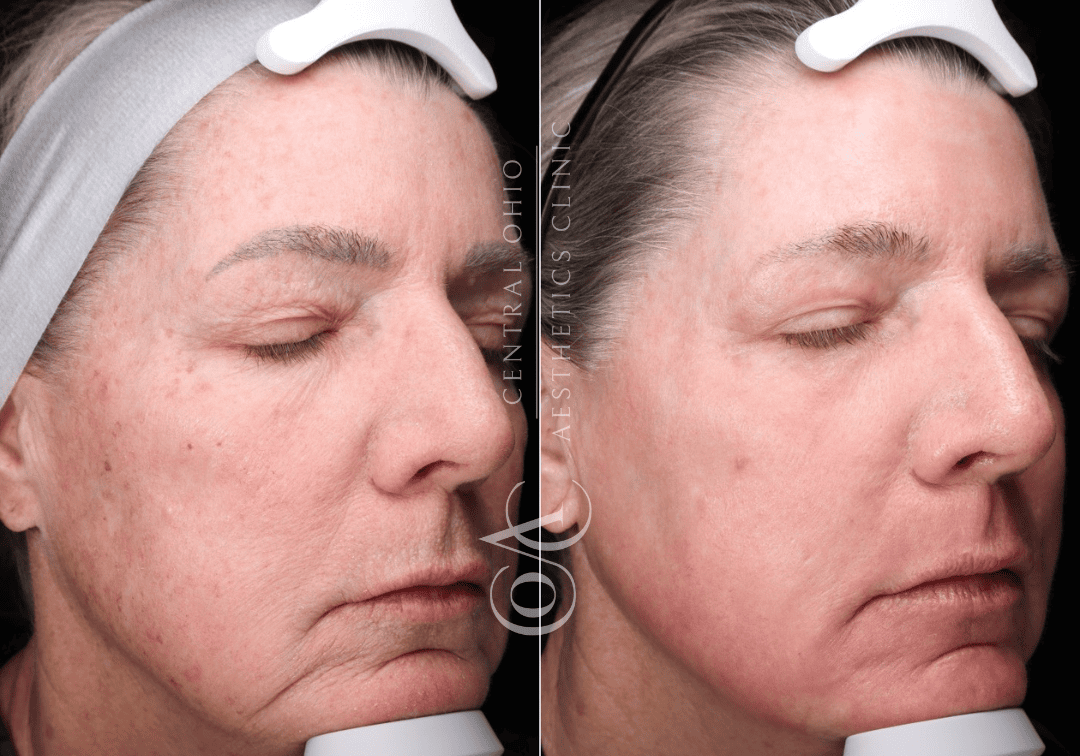 Laser Skin Resurfacing Before and After