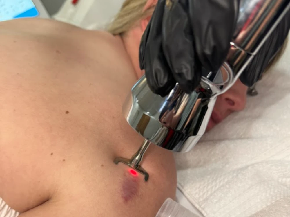 A person receives a laser treatment on the shoulder, targeting a bruise. A hand in a black glove holds the device, emitting a red light. The scene is clinical and focused. A person receives a laser treatment on the shoulder, targeting a bruise. A hand in a black glove holds the device, emitting a red light. The scene is clinical and focused.