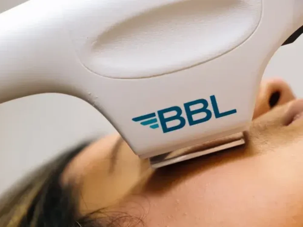 Close-up of a BBL laser device applying treatment to a person's face. The device is white with blue lettering, conveying a clinical and professional tone. Close-up of a BBL laser device applying treatment to a person's face. The device is white with blue lettering, conveying a clinical and professional tone.