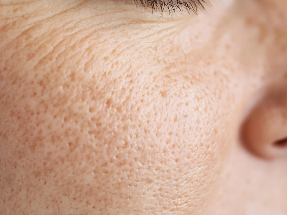 Close-up image of a person's cheek showing detailed skin texture with visible pores and fine lines. The skin tone is light and natural. Close-up image of a person's cheek showing detailed skin texture with visible pores and fine lines. The skin tone is light and natural.